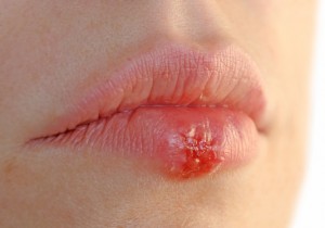 Lippenherpes